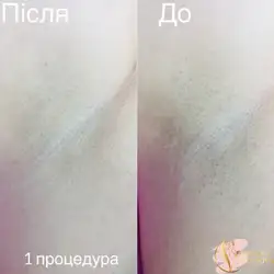 Войтова Оксана майстер епіляції