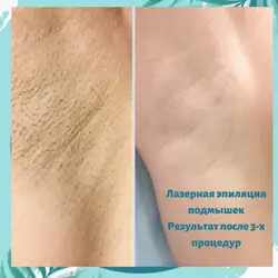 Лазерна епіляція Києв на діодином лазері Wow laser