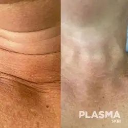 Plasma Skin Cosmetology — Харків
